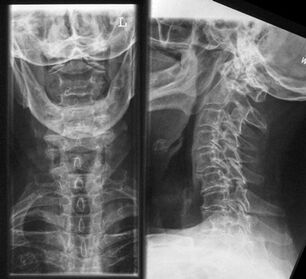 Radiografía da columna cervical un método para diagnosticar a osteocondrose