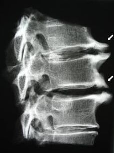 Os osteófitos da columna cervical causan dor no pescozo