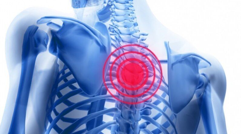 a dor nas costas pode asociarse cunha hernia de disco