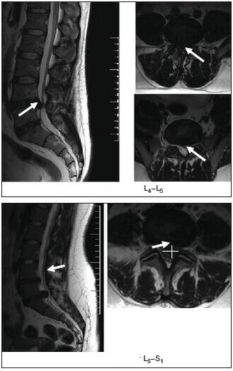 Exploración por resonancia magnética da hernia discal da columna vertebral