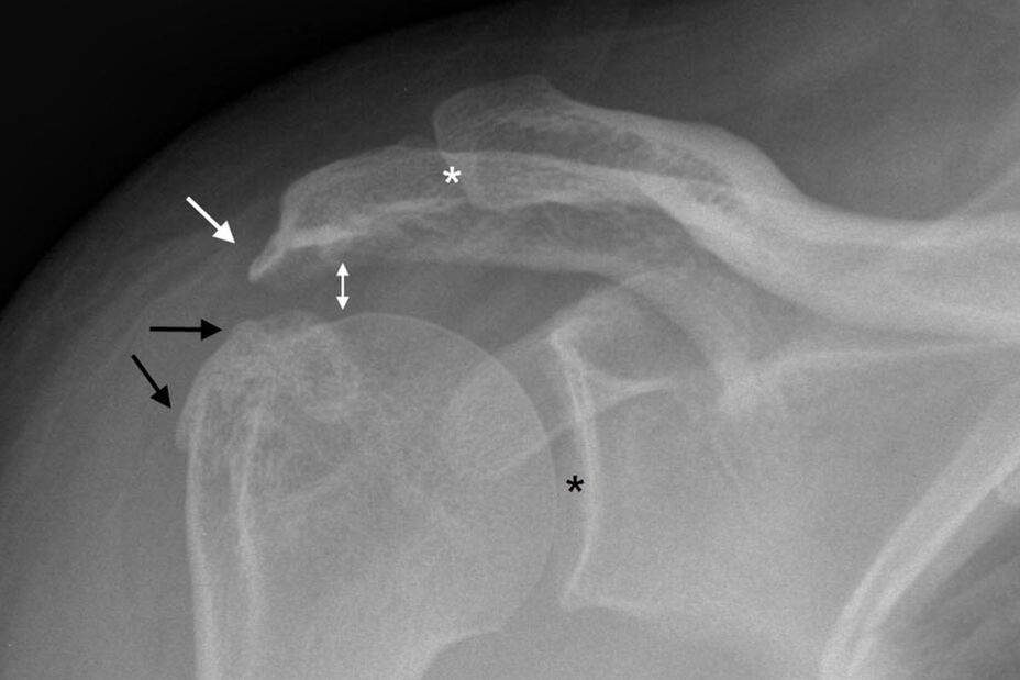 artrose da articulación do ombreiro na radiografía