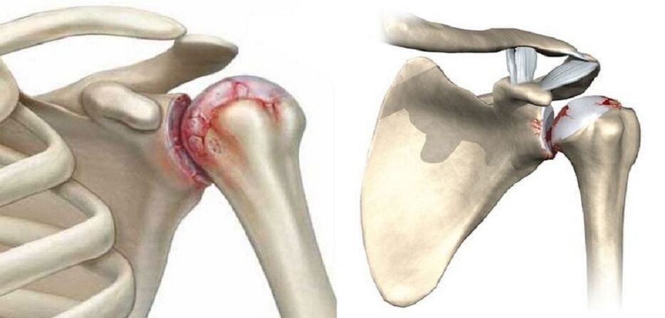 destrución da articulación do ombreiro con artrose