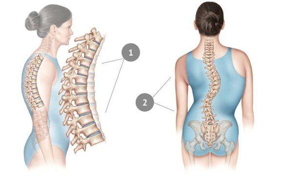 curvatura da columna vertebral como causa da osteocondrose torácica