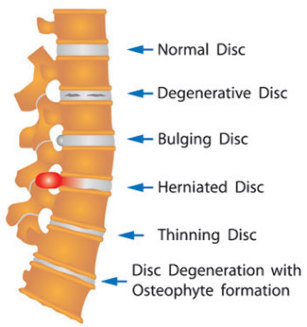 varios mal disco da columna vertebral